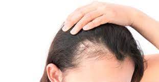 تساقط الشعر بعد الولادة